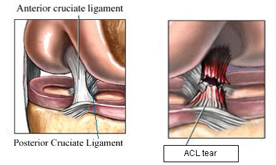 torn acl